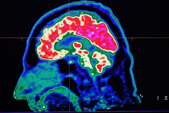 A picture of a human brain taken by a positron emission tomography scanner, also called PET scan, is seen on a screen on January 9, 2019, at the Regional and University Hospital Center of Brest (CRHU - Centre Hospitalier Régional et Universitaire de Brest), western France. - The CHRU of Brest has just acquired a new molecular imaging device, the most advanced in France today according to the hospital center, capable of better detecting deep lesions and especially cancerous pathologies, the hospital announced on January 9, 2019. (Photo by Fred TANNEAU / AFP)        (Photo credit should read FRED TANNEAU/AFP/Getty Images)