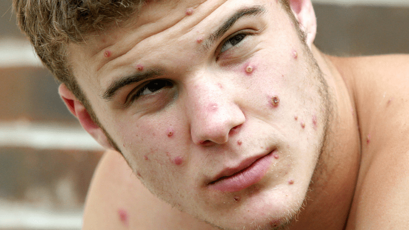 Student Julian Glen is believed to have contracted the monkeypox virus from his pet dog (source: PA)
